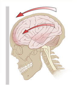 538px-Concussion_mechanics_svg.jpg